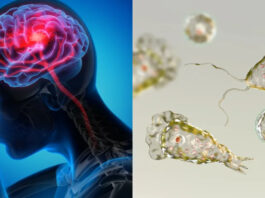 Karachi Claims Another Life to Brain-Eating Amoeba